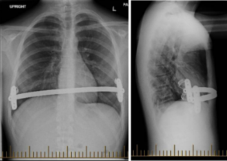 Une première canadienne: un adolescent de 17 ans est le premier patient canadien à obtenir une chirurgie minimalement invasive pour une malformation de la paroi de la cage thoracique